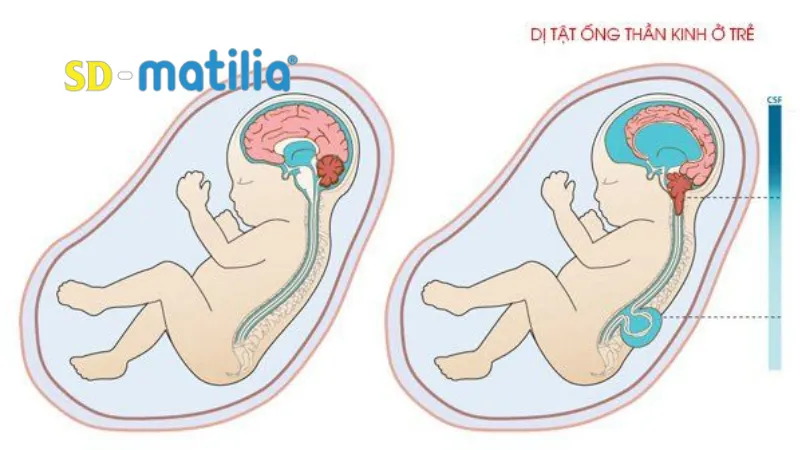 Sữa Matilia có mấy loại: Giảm nguy cơ dị tật dây thần kinh ở trẻ