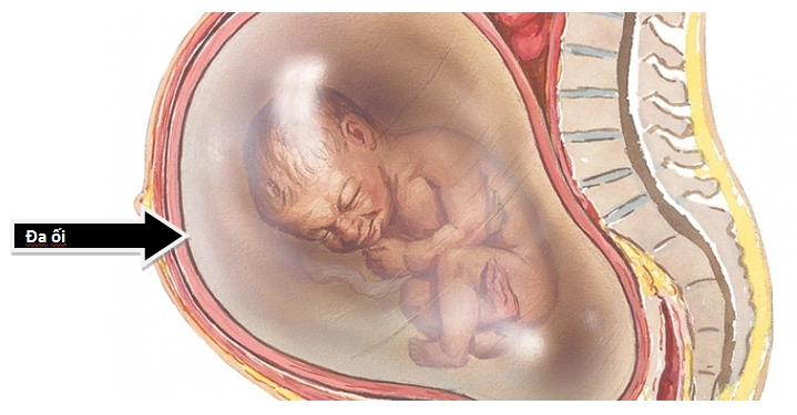 Mang thai dư ối có sao không?